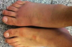 arata-ca-un-zombie-cum-s-a-transformat-piciorul-unui-luptator-din-mma-dupa-meci-foto